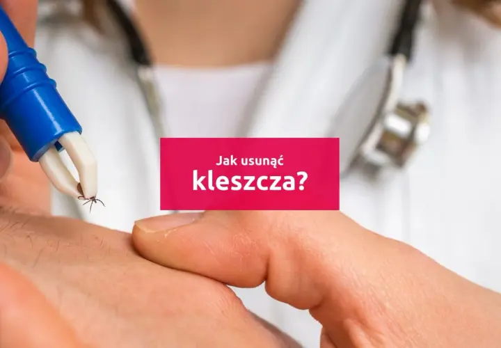 Pęseta usuwa kleszcza z ludzkiej skóry. Dowiedz się, jak wyciągnąć kleszcza bezpiecznie i skutecznie.