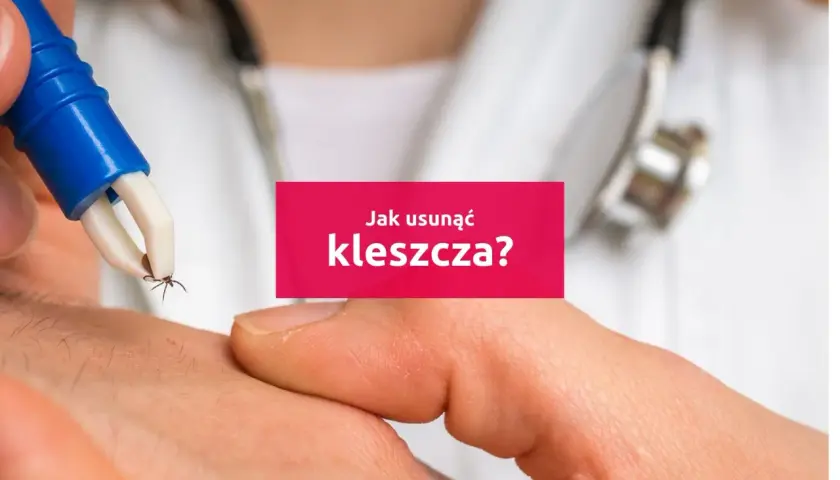 Pęseta usuwa kleszcza z ludzkiej skóry. Dowiedz się, jak wyciągnąć kleszcza bezpiecznie i skutecznie.