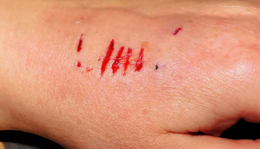 Lekkie ugryzienie przez psa szczepionego. Kilka czerwonych zadrapań na skórze dłoni, z niewielką ilością krwi.
