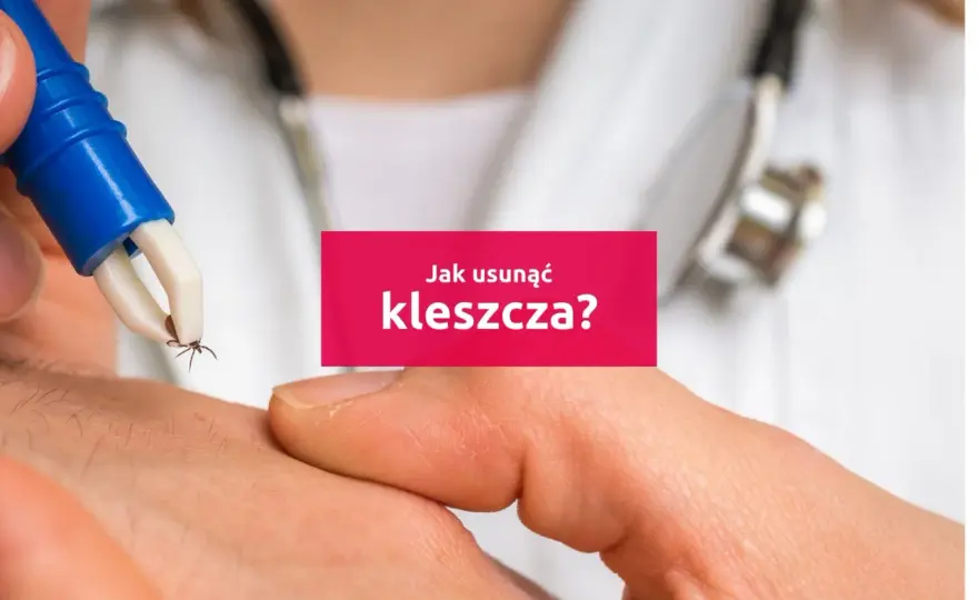 Jak wyciągnąć kleszcza bez błędów i kiedy iść do lekarza