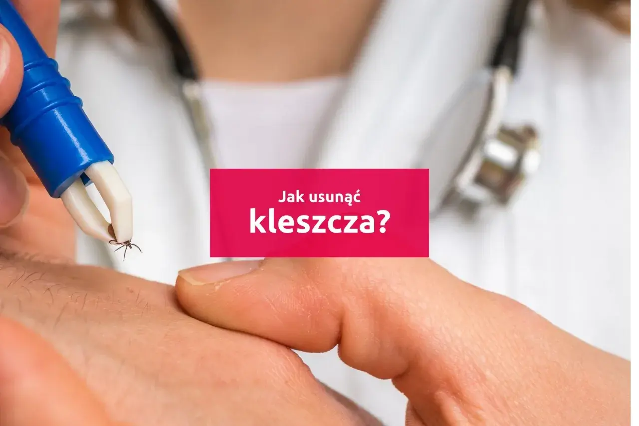 Pęseta usuwa kleszcza z ludzkiej skóry. Dowiedz się, jak wyciągnąć kleszcza bezpiecznie i skutecznie.